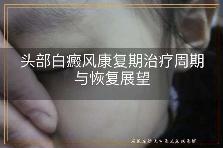 头部白癜风康复期治疗周期与恢复展望
