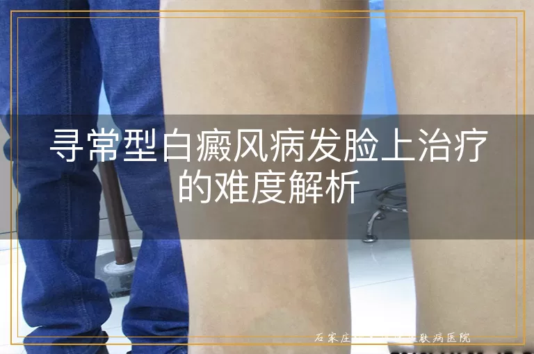 寻常型白癜风病发脸上治疗的难度解析
