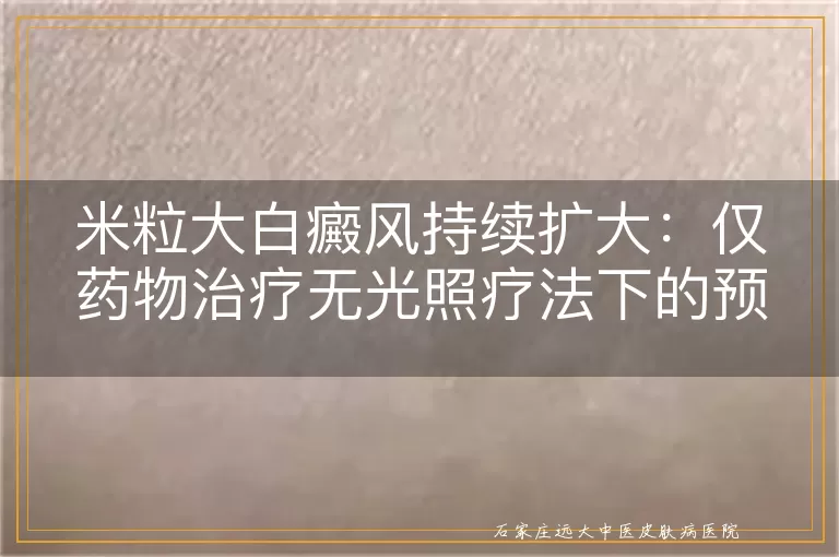 米粒大白癜风持续扩大：仅药物治疗无光照疗法下的预期康复周期探讨