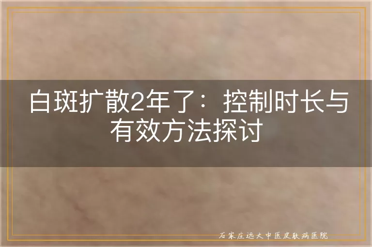 白斑扩散2年了：控制时长与有效方法探讨