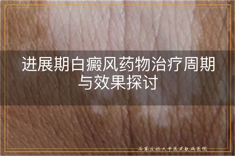 进展期白癜风药物治疗周期与效果探讨