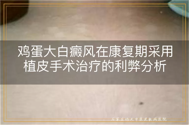 鸡蛋大白癜风在康复期采用植皮手术治疗的利弊分析
