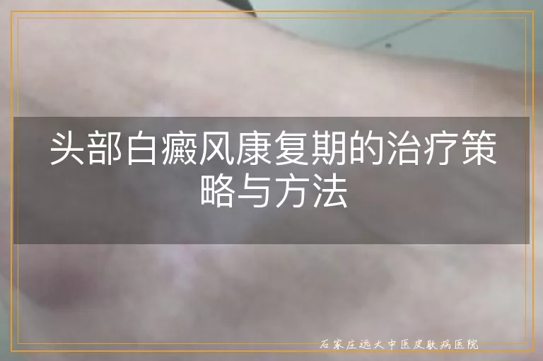 头部白癜风康复期的治疗策略与方法