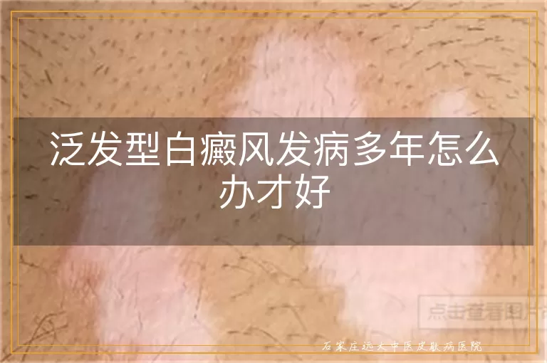 泛发型白癜风发病多年怎么办才好