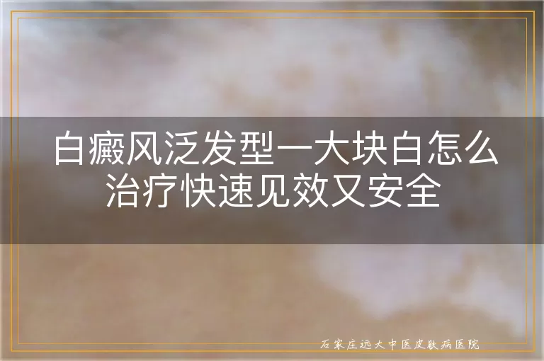 白癜风泛发型一大块白怎么治疗快速见效又安全