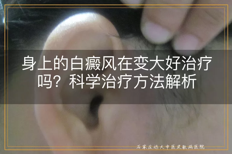 身上的白癜风在变大好治疗吗?科学治疗方法解析