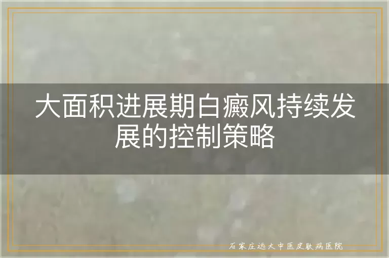 大面积进展期白癜风持续发展的控制策略