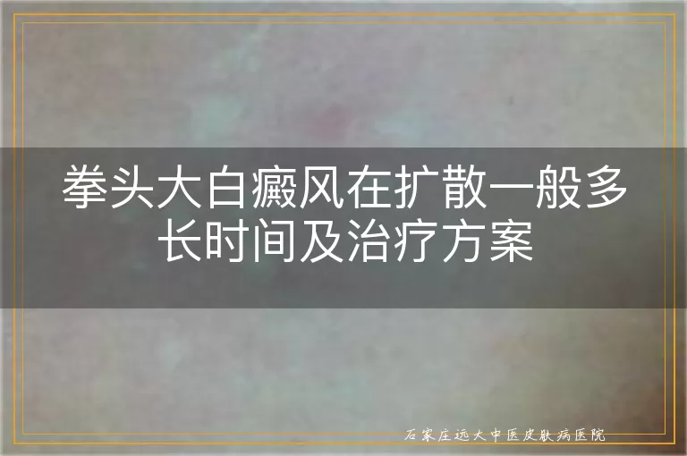 拳头大白癜风在扩散一般多长时间及治疗方案