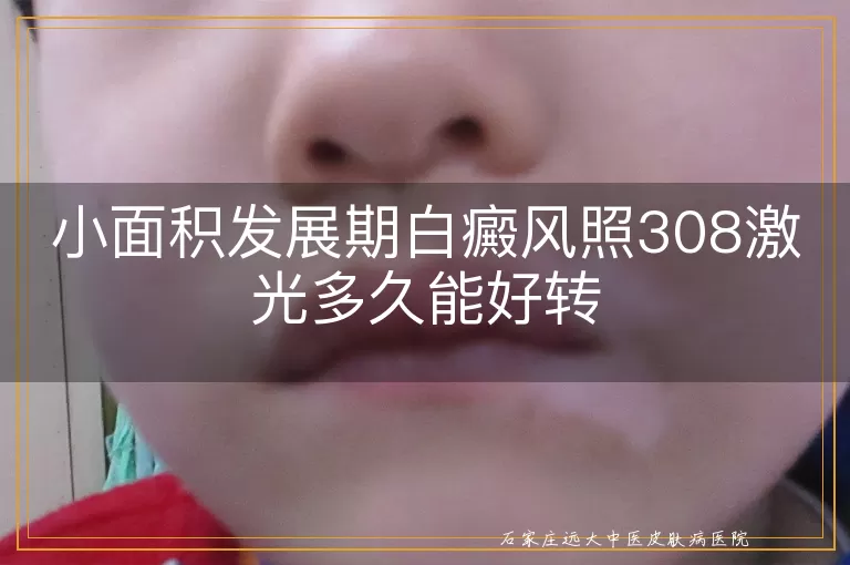 小面积发展期白癜风照308激光多久能好转