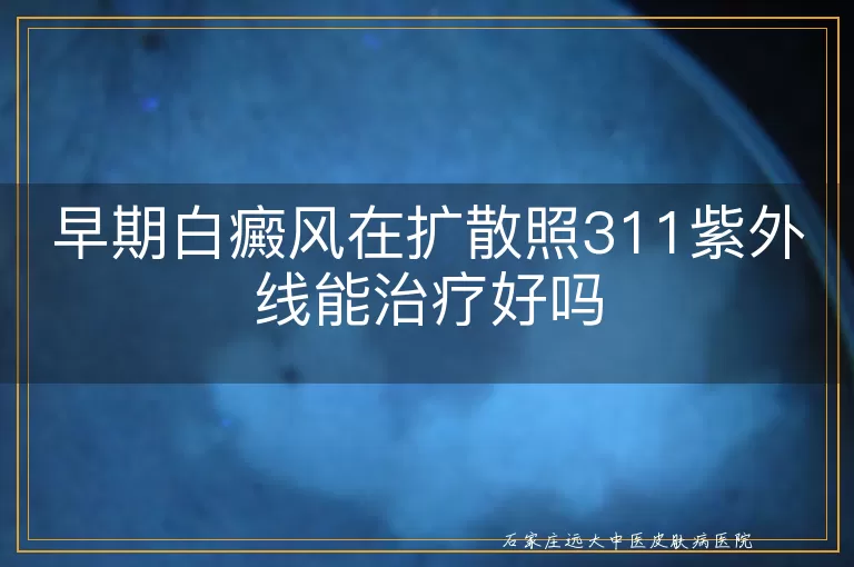 早期白癜风在扩散照311紫外线能治疗好吗