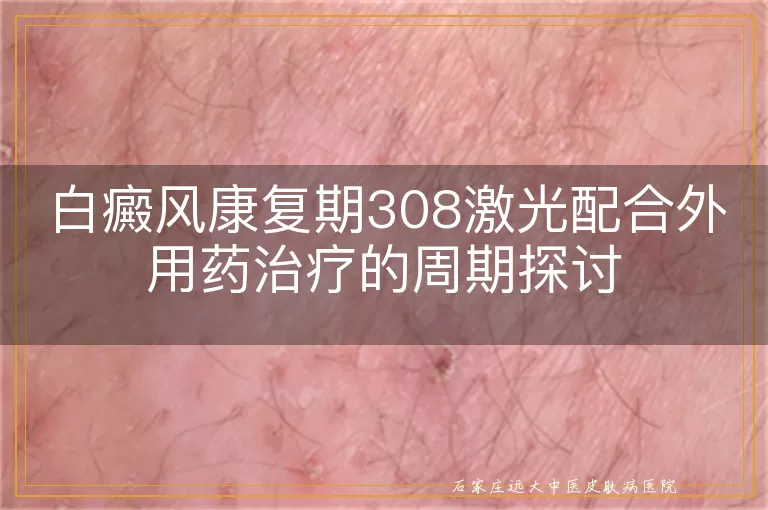 白癜风康复期308激光配合外用药治疗的周期探讨