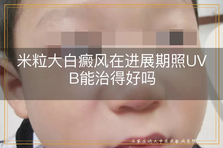 米粒大白癜风在进展期照UVB能治得好吗