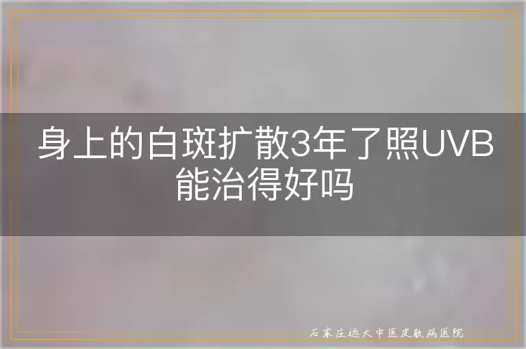 身上的白斑扩散3年了照UVB能治得好吗
