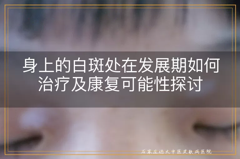 身上的白斑处在发展期如何治疗及康复可能性探讨