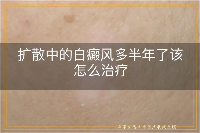 扩散中的白癜风多半年了该怎么治疗
