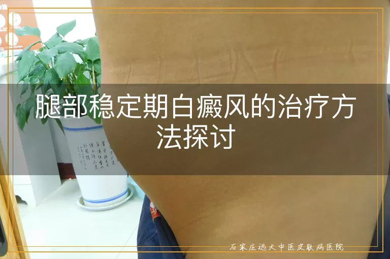 腿部稳定期白癜风的治疗方法探讨