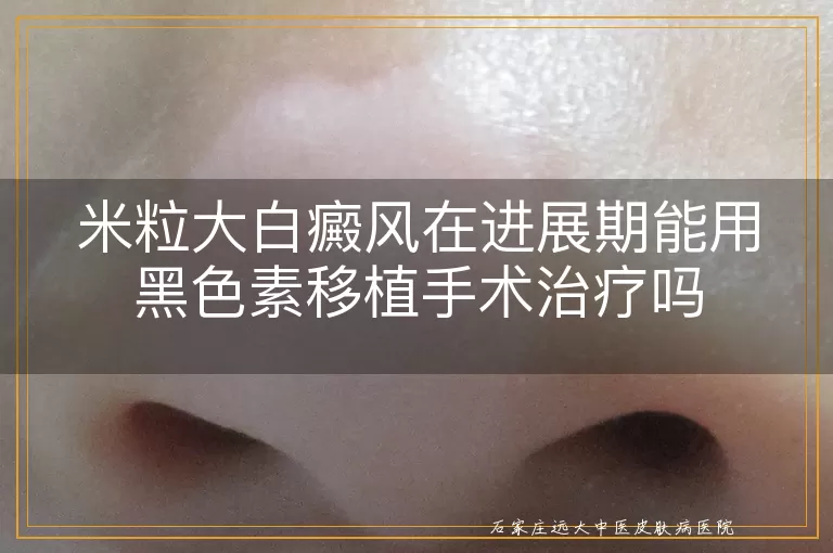 米粒大白癜风在进展期能用黑色素移植手术治疗吗