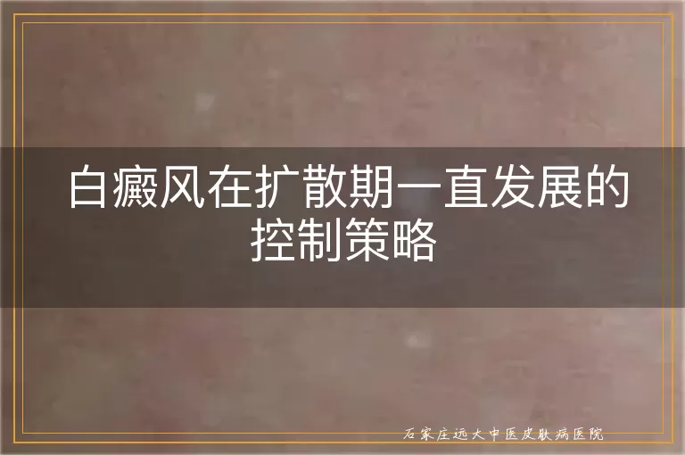 白癜风在扩散期一直发展的控制策略