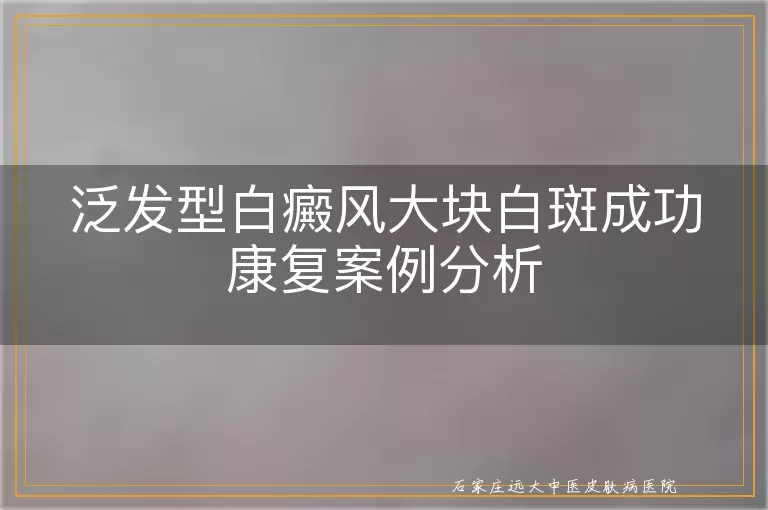 泛发型白癜风大块白斑成功康复案例分析