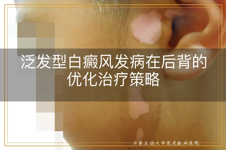 泛发型白癜风发病在后背的优化治疗策略