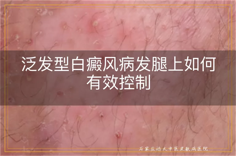 泛发型白癜风病发腿上如何有效控制