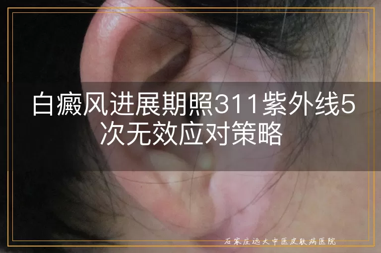 白癜风进展期照311紫外线5次无效应对策略