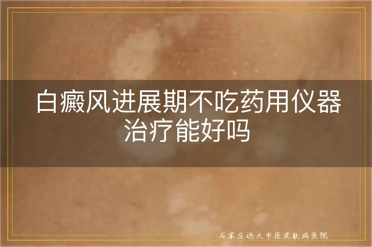 白癜风进展期不吃药用仪器治疗能好吗