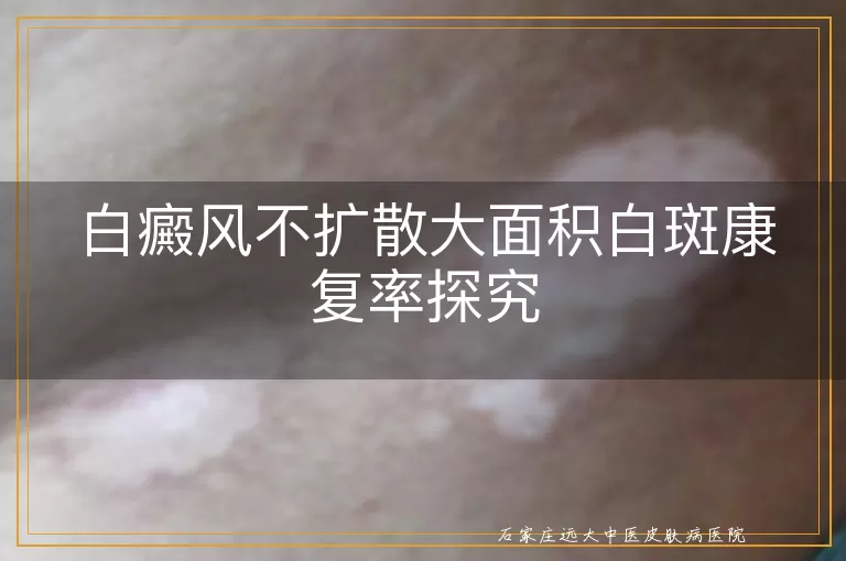 白癜风不扩散大面积白斑康复率探究