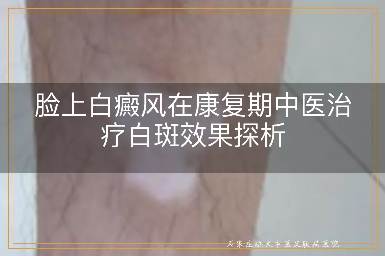脸上白癜风在康复期中医治疗白斑效果探析