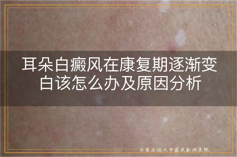 耳朵白癜风在康复期逐渐变白该怎么办及原因分析