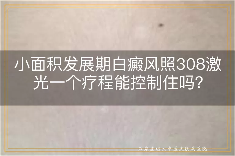 小面积发展期白癜风照308激光一个疗程能控制住吗？
