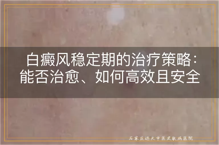 白癜风稳定期的治疗策略：能否治愈、如何高效且安全地进行