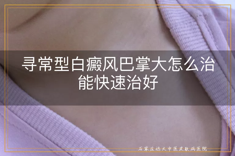 寻常型白癜风巴掌大怎么治能快速治好
