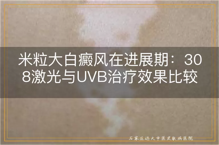 米粒大白癜风在进展期：308激光与UVB治疗效果比较