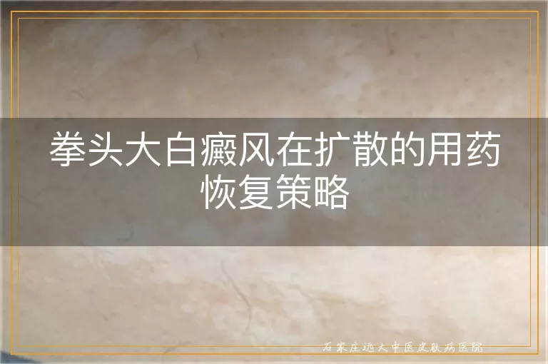拳头大白癜风在扩散的用药恢复策略