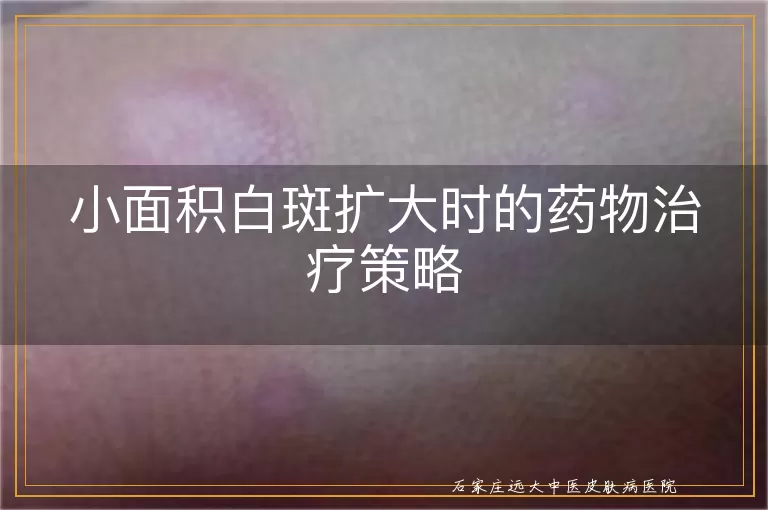小面积白斑扩大时的药物治疗策略