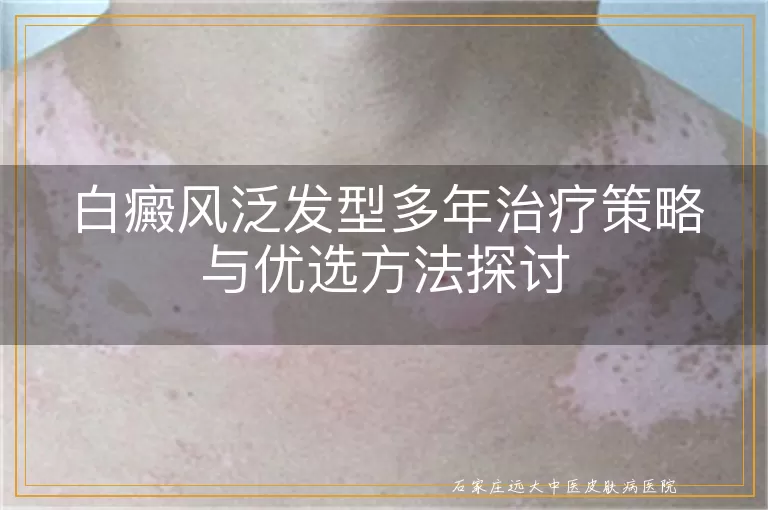 白癜风泛发型多年治疗策略与优选方法探讨