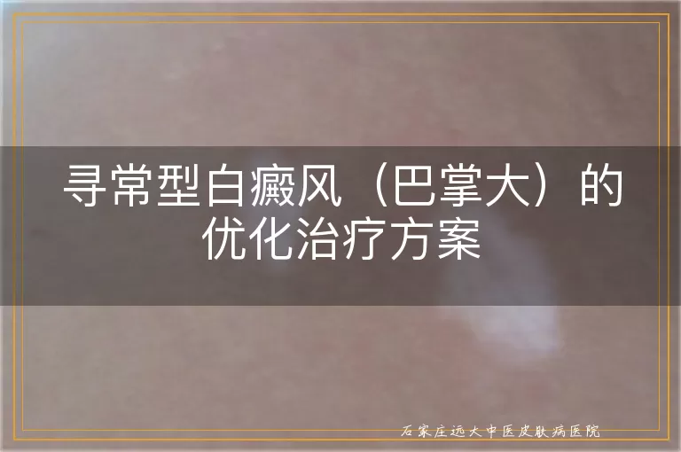 寻常型白癜风（巴掌大）的优化治疗方案