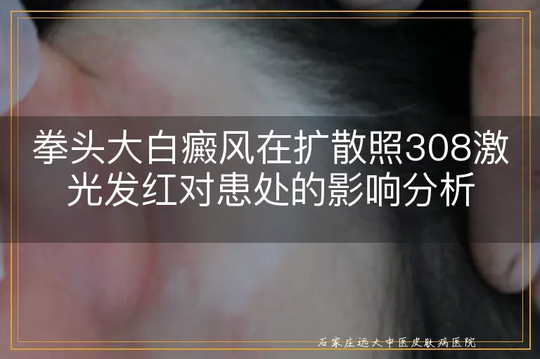 拳头大白癜风在扩散照308激光发红对患处的影响分析