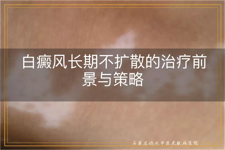 白癜风长期不扩散的治疗前景与策略