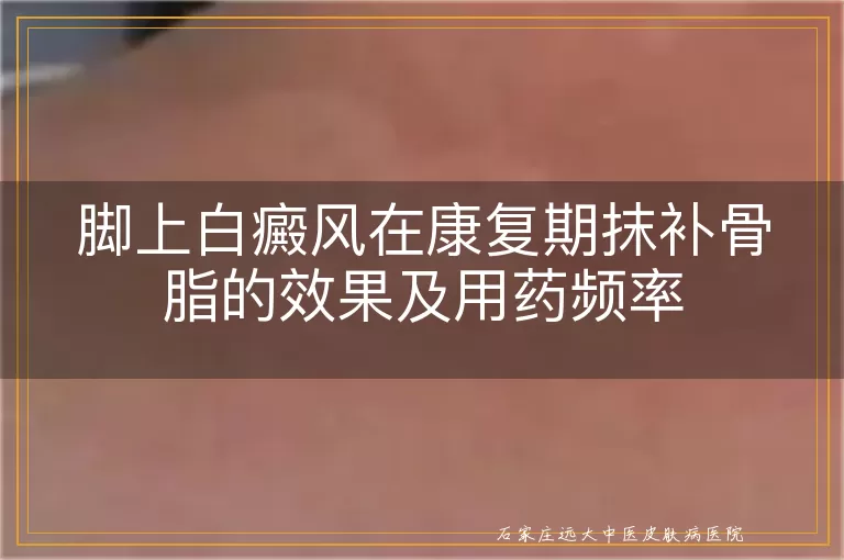 脚上白癜风在康复期抹补骨脂的效果及用药频率