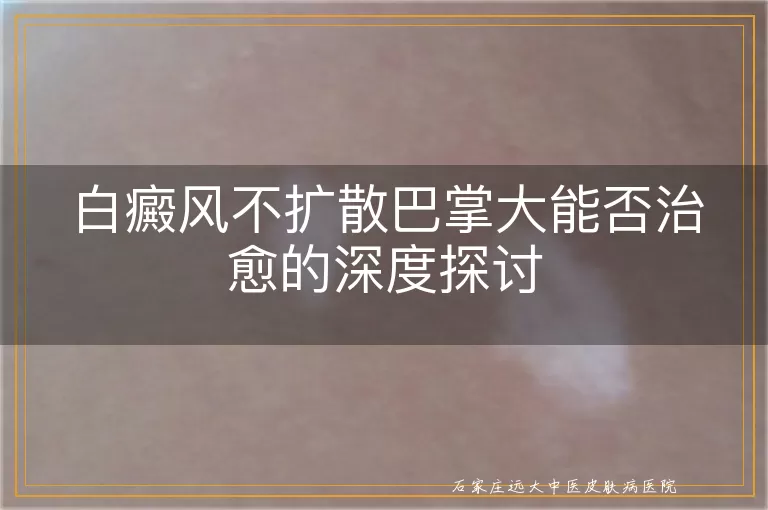 白癜风不扩散巴掌大能否治愈的深度探讨