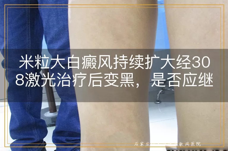 米粒大白癜风持续扩大经308激光治疗后变黑，是否应继续照射？