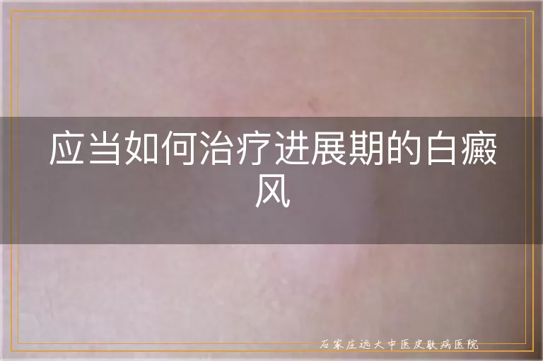 应当如何治疗进展期的白癜风