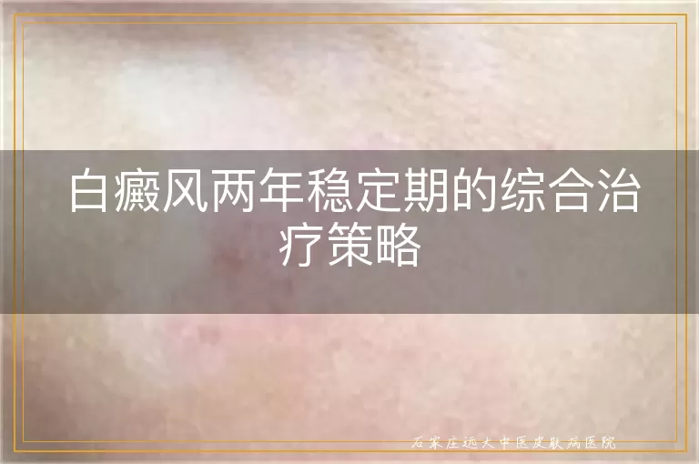 白癜风两年稳定期的综合治疗策略