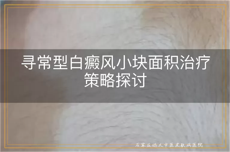 寻常型白癜风小块面积治疗策略探讨
