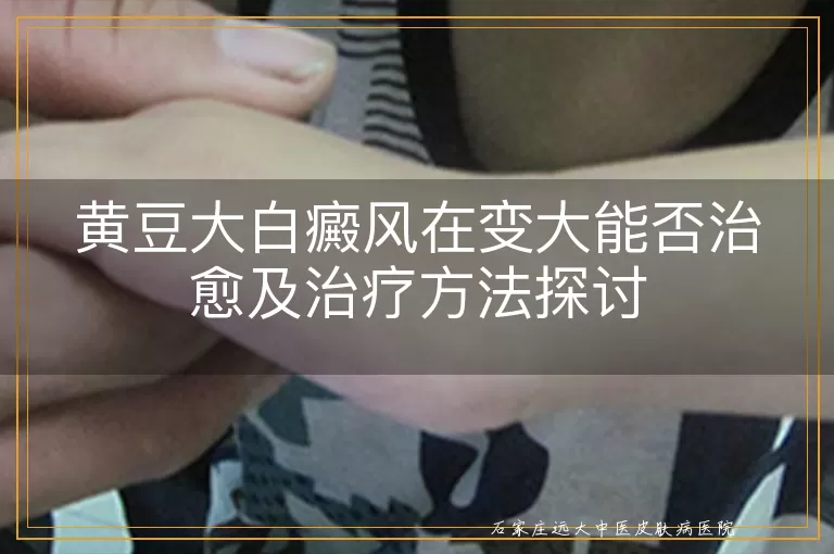黄豆大白癜风在变大能否治愈及治疗方法探讨
