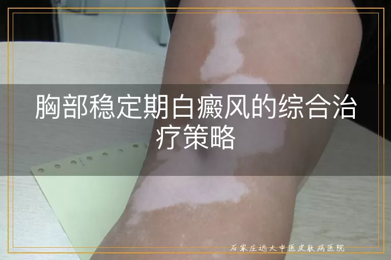 胸部稳定期白癜风的综合治疗策略