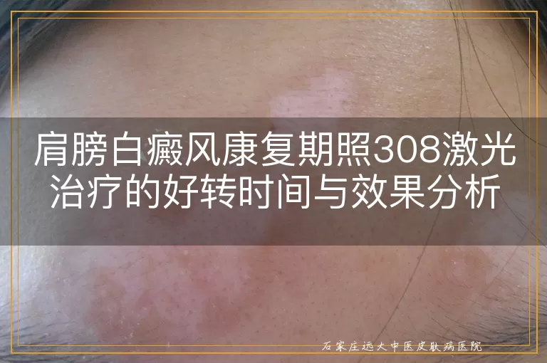 肩膀白癜风康复期照308激光治疗的好转时间与效果分析