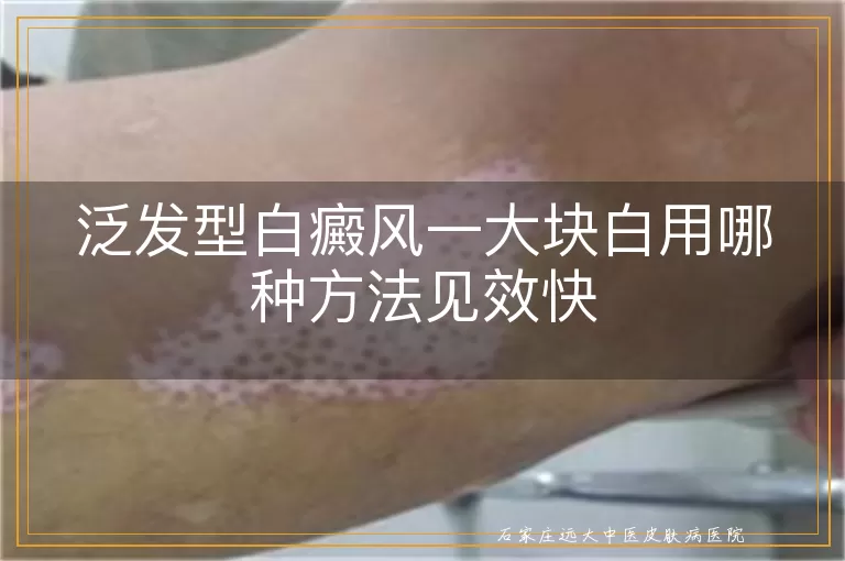 泛发型白癜风一大块白用哪种方法见效快
